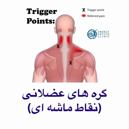 گره‌های عضلانی